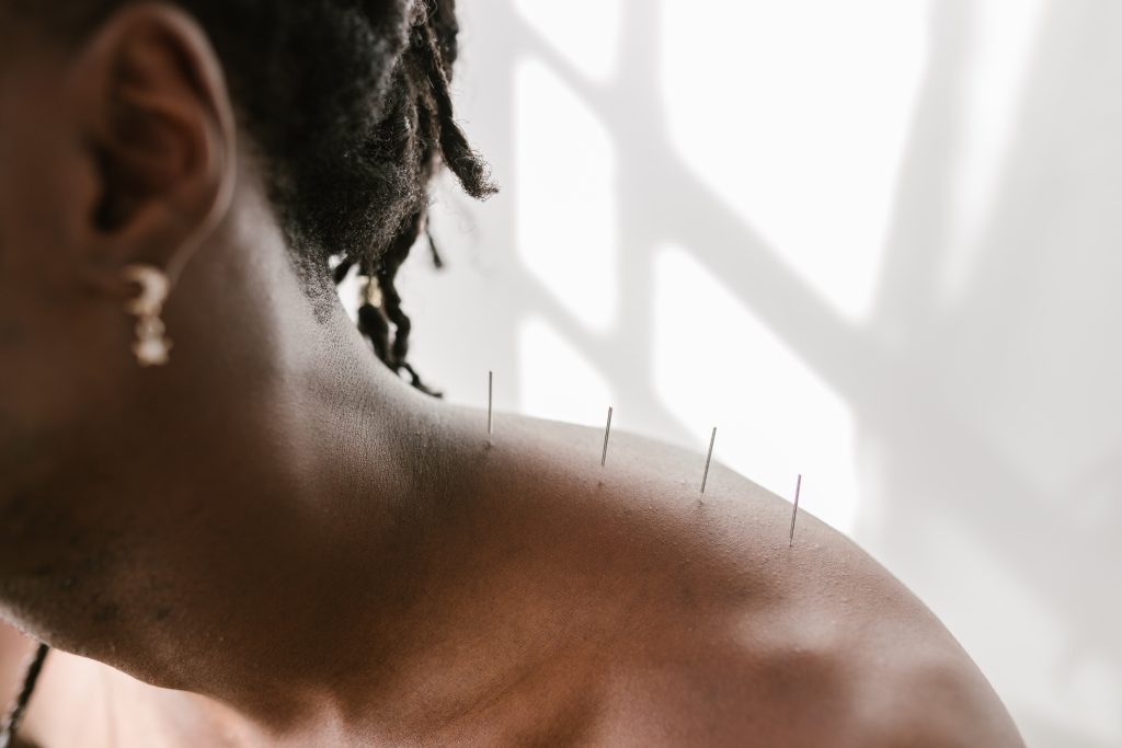 Medical Acupuncture: What is it and how can it help you?